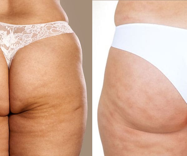 cellulite vs stretch marks pharmaquality